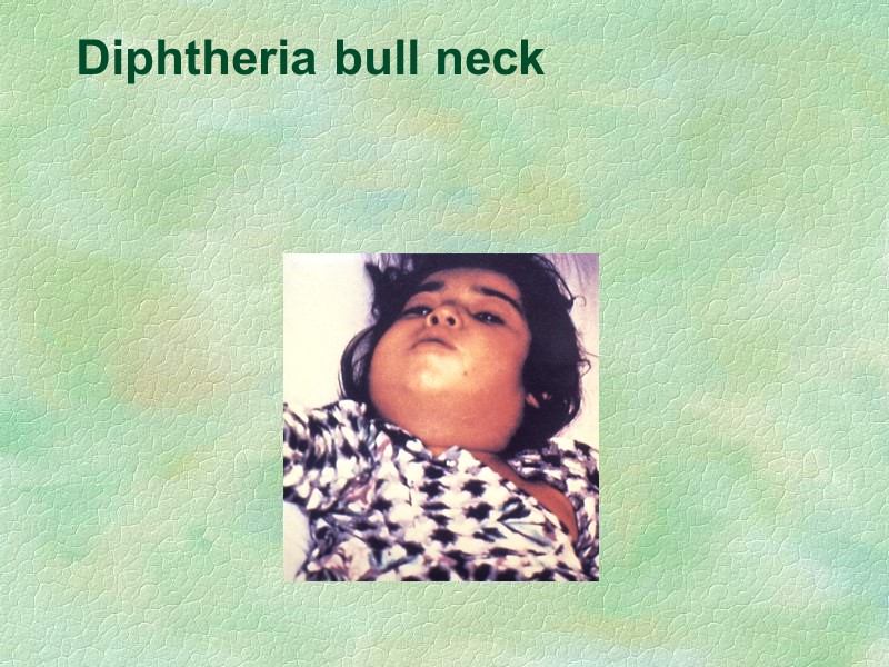 Diphtheria bull neck